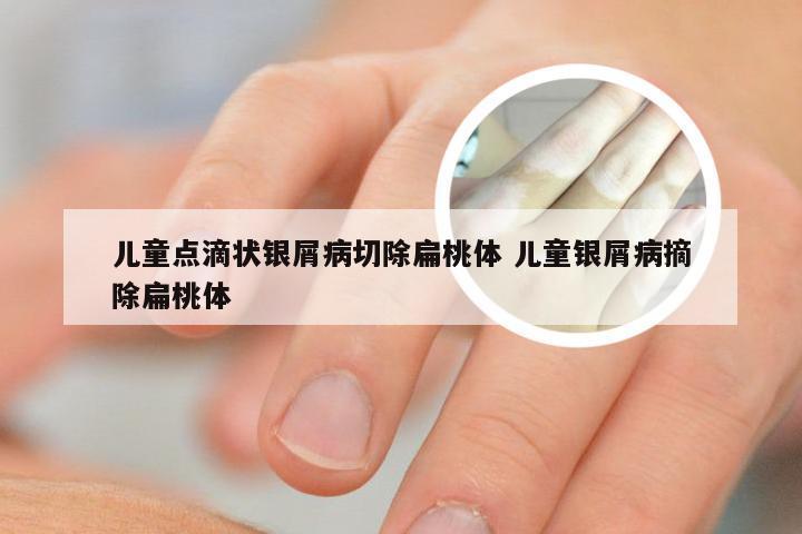 儿童点滴状银屑病切除扁桃体 儿童银屑病摘除扁桃体