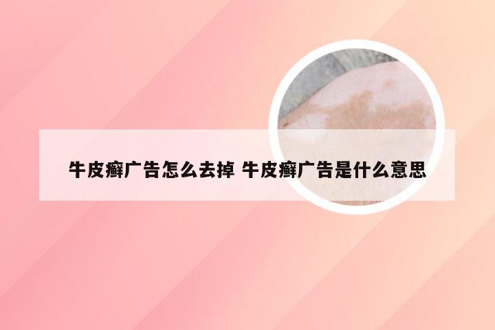 牛皮癣广告怎么去掉 牛皮癣广告是什么意思