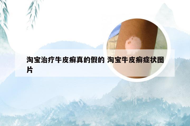 淘宝治疗牛皮癣真的假的 淘宝牛皮癣症状图片