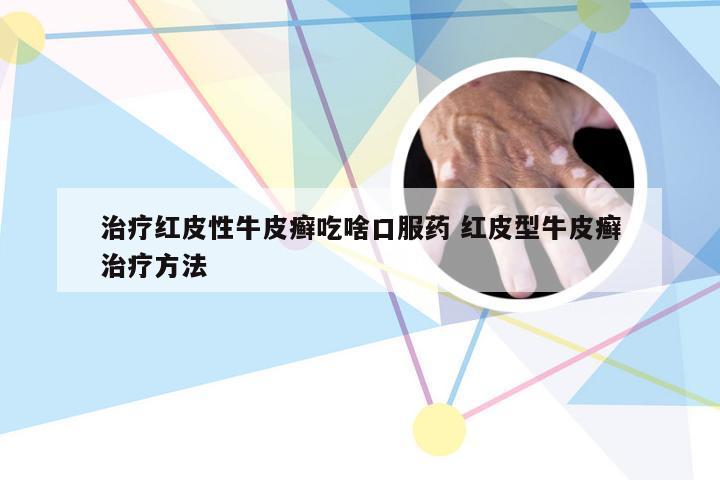 治疗红皮性牛皮癣吃啥口服药 红皮型牛皮癣治疗方法