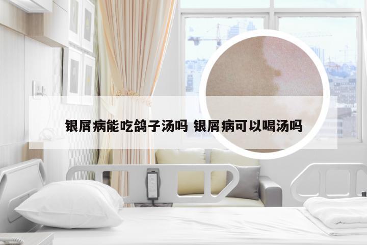 银屑病能吃鸽子汤吗 银屑病可以喝汤吗