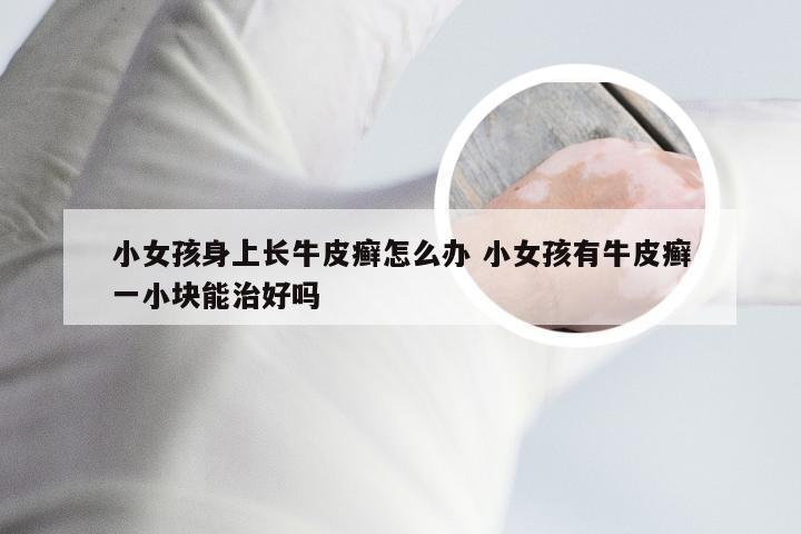 小女孩身上长牛皮癣怎么办 小女孩有牛皮癣一小块能治好吗