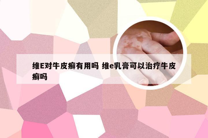 维E对牛皮癣有用吗 维e乳膏可以治疗牛皮癣吗