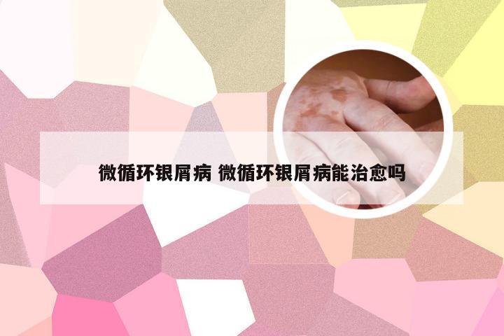 微循环银屑病 微循环银屑病能治愈吗
