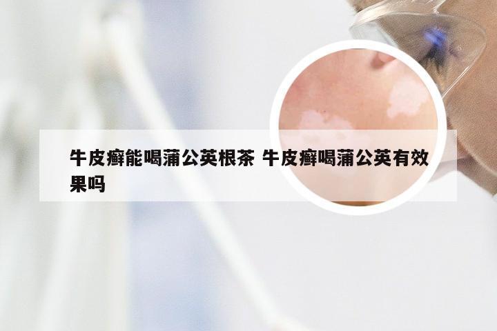 牛皮癣能喝蒲公英根茶 牛皮癣喝蒲公英有效果吗