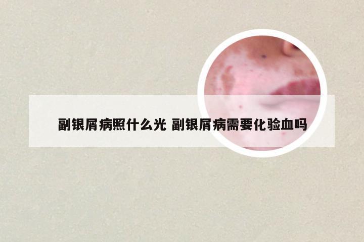 副银屑病照什么光 副银屑病需要化验血吗
