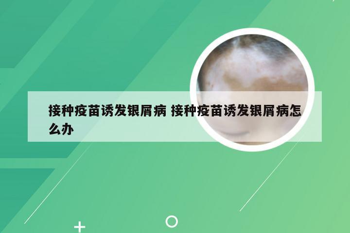 接种疫苗诱发银屑病 接种疫苗诱发银屑病怎么办
