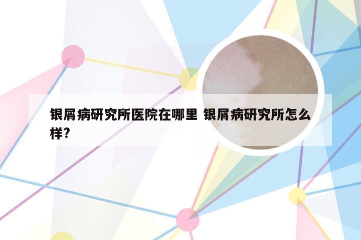 银屑病研究所医院在哪里 银屑病研究所怎么样?