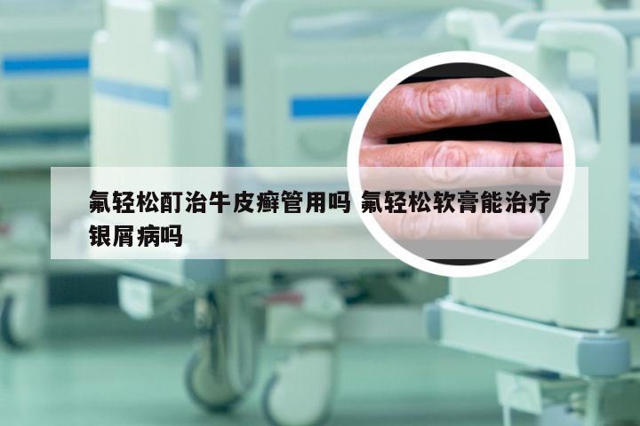 氟轻松酊治牛皮癣管用吗 氟轻松软膏能治疗银屑病吗