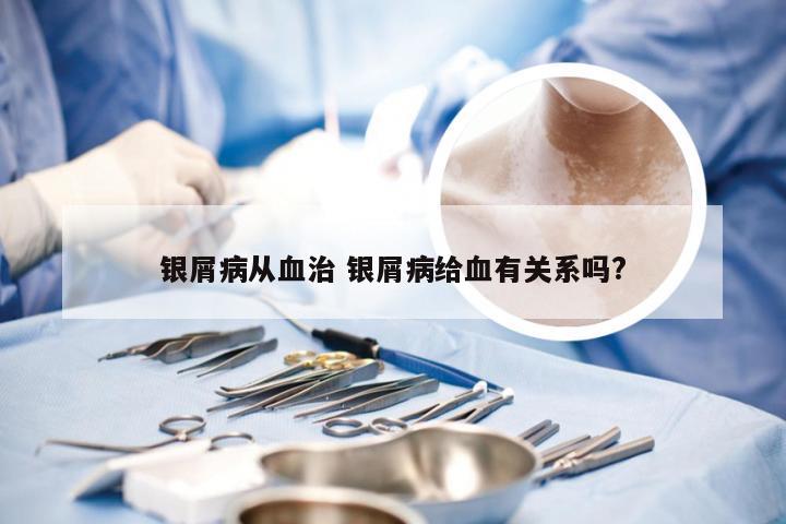 银屑病从血治 银屑病给血有关系吗?