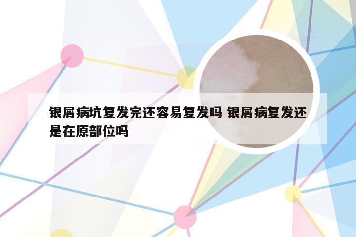 银屑病坑复发完还容易复发吗 银屑病复发还是在原部位吗