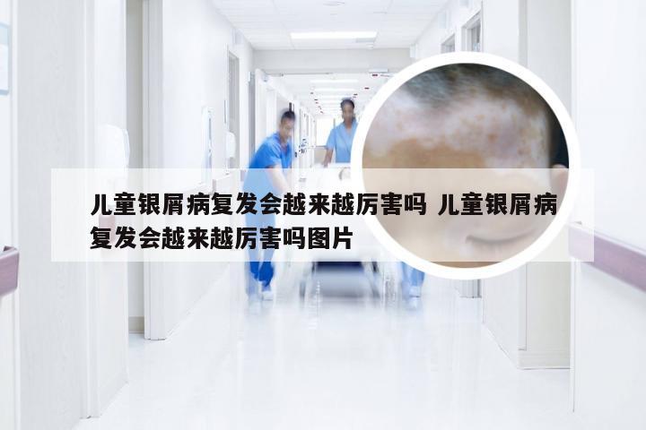 儿童银屑病复发会越来越厉害吗 儿童银屑病复发会越来越厉害吗图片