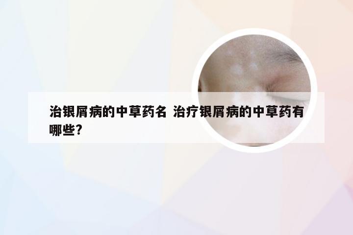 治银屑病的中草药名 治疗银屑病的中草药有哪些?