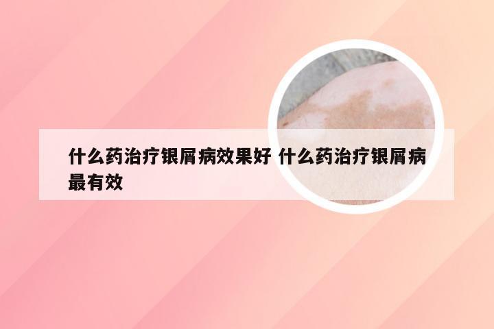 什么药治疗银屑病效果好 什么药治疗银屑病最有效