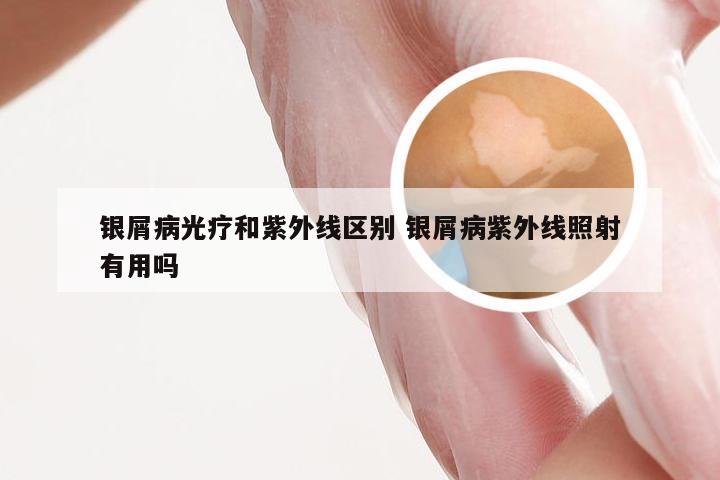 银屑病光疗和紫外线区别 银屑病紫外线照射有用吗