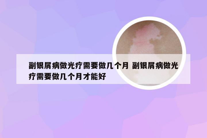 副银屑病做光疗需要做几个月 副银屑病做光疗需要做几个月才能好