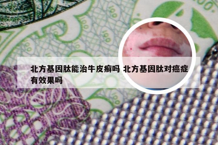 北方基因肽能治牛皮癣吗 北方基因肽对癌症有效果吗