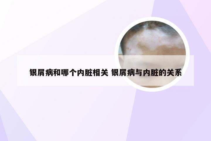 银屑病和哪个内脏相关 银屑病与内脏的关系