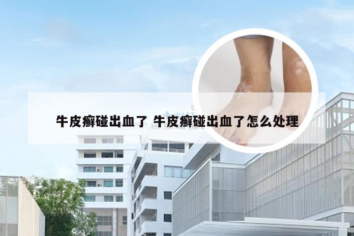 牛皮癣碰出血了 牛皮癣碰出血了怎么处理