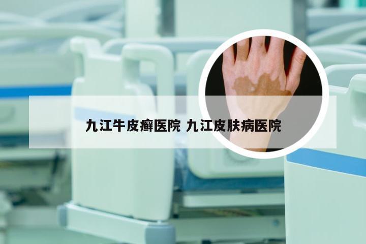 九江牛皮癣医院 九江皮肤病医院