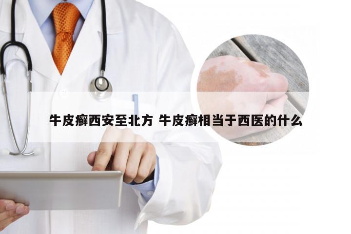 牛皮癣西安至北方 牛皮癣相当于西医的什么