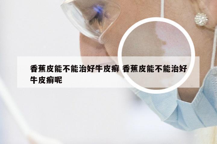 香蕉皮能不能治好牛皮癣 香蕉皮能不能治好牛皮癣呢
