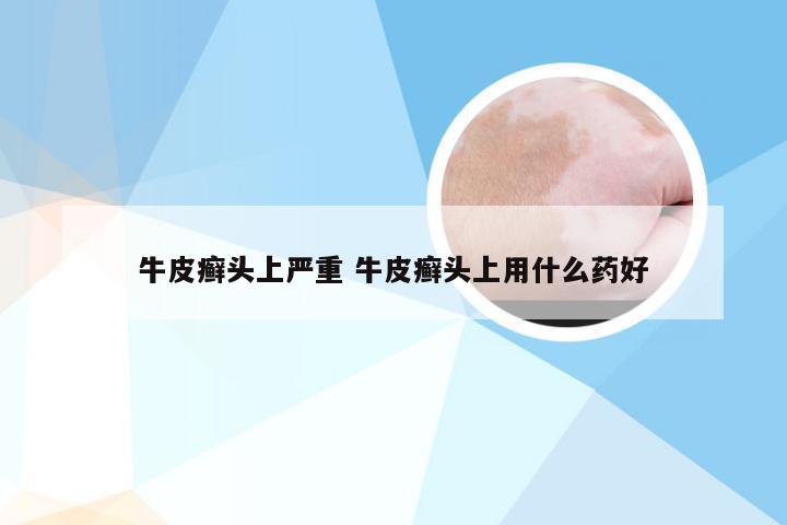 牛皮癣头上严重 牛皮癣头上用什么药好