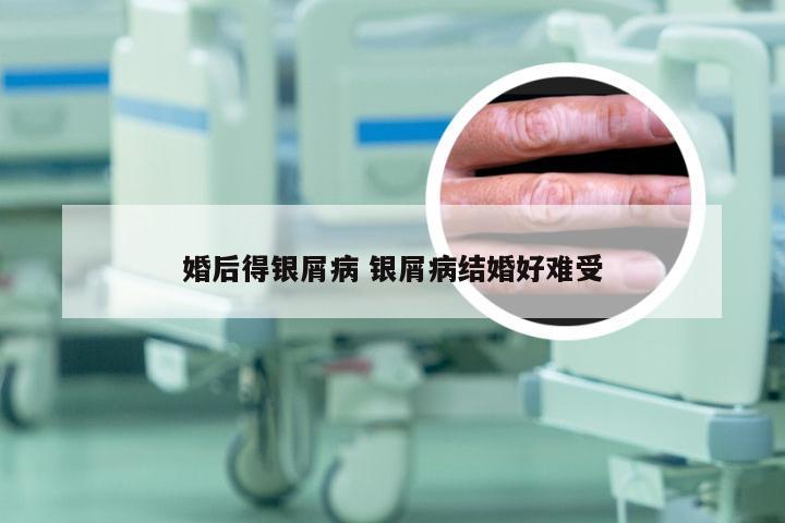 婚后得银屑病 银屑病结婚好难受