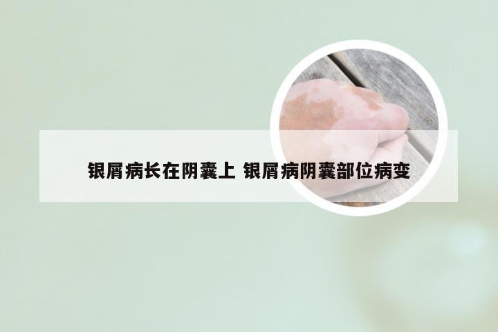 银屑病长在阴囊上 银屑病阴囊部位病变