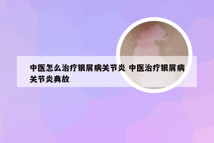中医怎么治疗银屑病关节炎 中医治疗银屑病关节炎典故