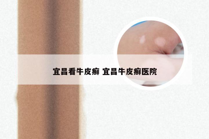 宜昌看牛皮癣 宜昌牛皮癣医院