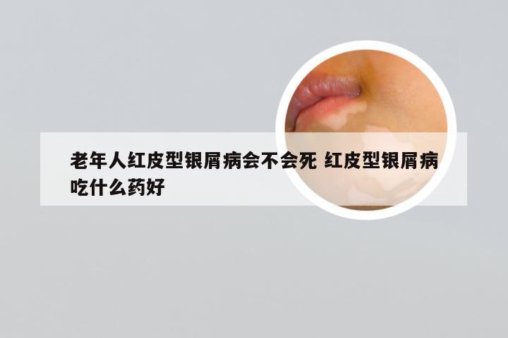 老年人红皮型银屑病会不会死 红皮型银屑病吃什么药好