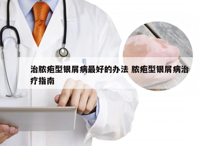 治脓疱型银屑病最好的办法 脓疱型银屑病治疗指南