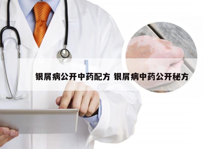 银屑病公开中药配方 银屑病中药公开秘方