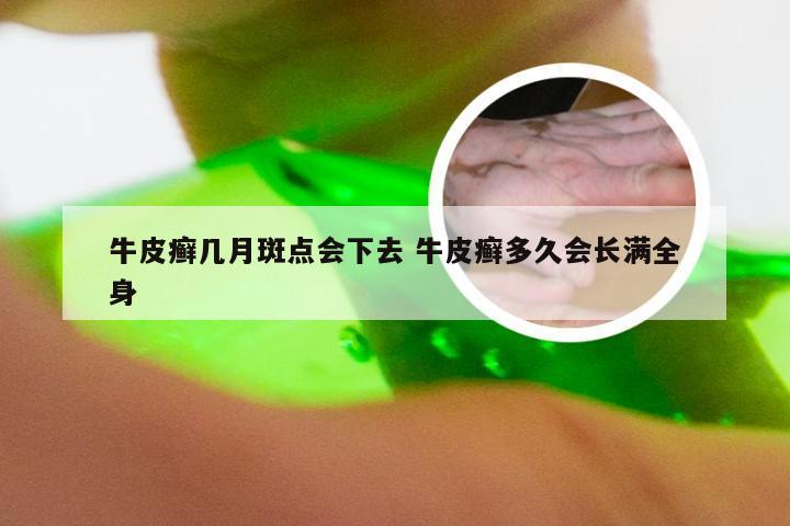 牛皮癣几月斑点会下去 牛皮癣多久会长满全身