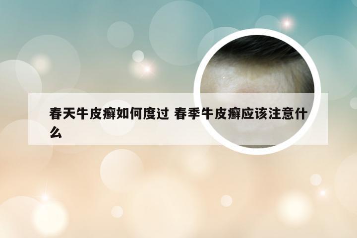 春天牛皮癣如何度过 春季牛皮癣应该注意什么