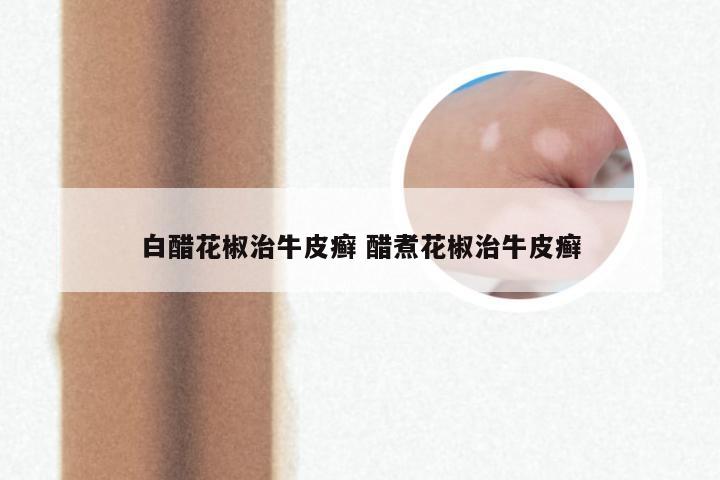 白醋花椒治牛皮癣 醋煮花椒治牛皮癣