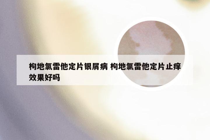 枸地氯雷他定片银屑病 枸地氯雷他定片止痒效果好吗