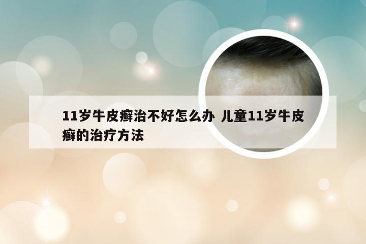 11岁牛皮癣治不好怎么办 儿童11岁牛皮癣的治疗方法