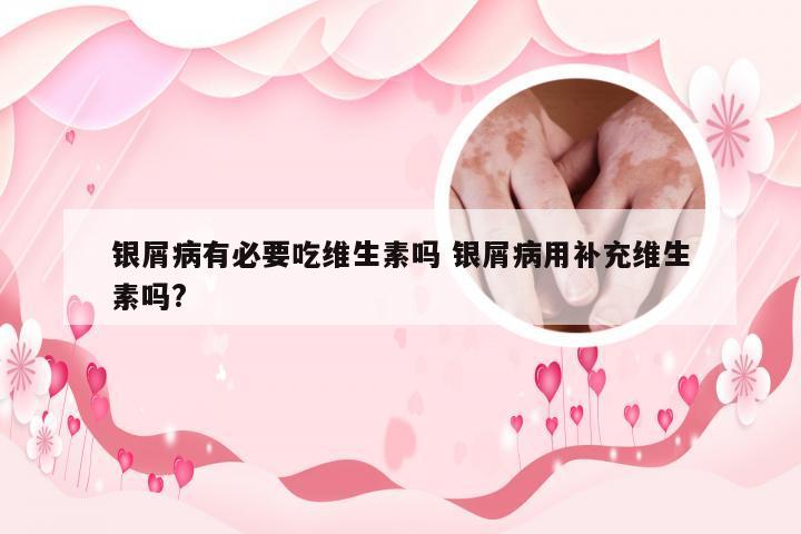 银屑病有必要吃维生素吗 银屑病用补充维生素吗?