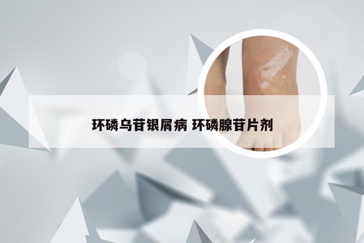 环磷乌苷银屑病 环磷腺苷片剂