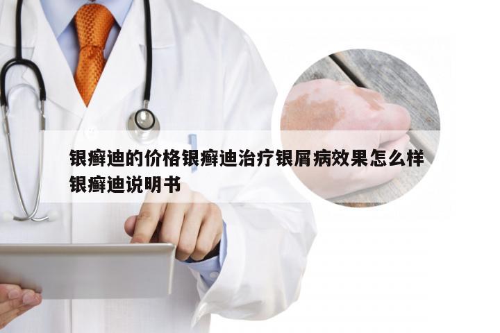 银癣迪的价格银癣迪治疗银屑病效果怎么样 银癣迪说明书