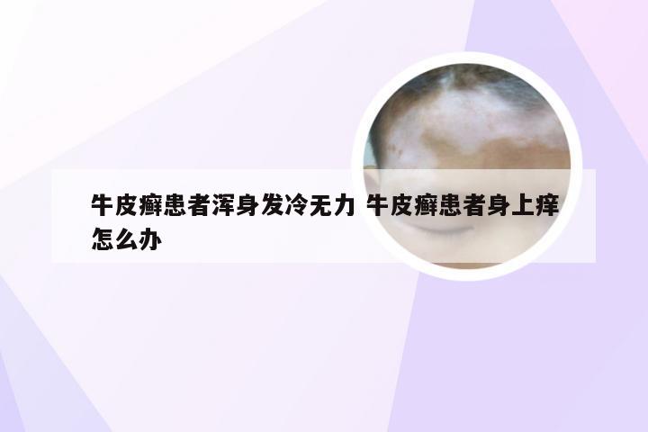 牛皮癣患者浑身发冷无力 牛皮癣患者身上痒怎么办