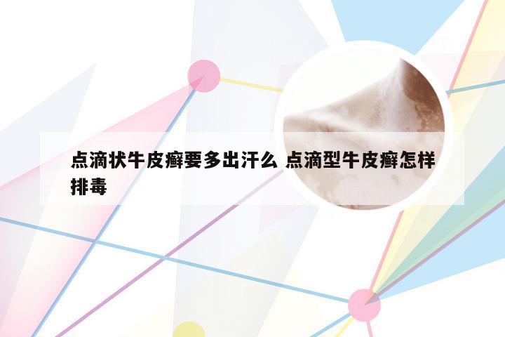 点滴状牛皮癣要多出汗么 点滴型牛皮癣怎样排毒