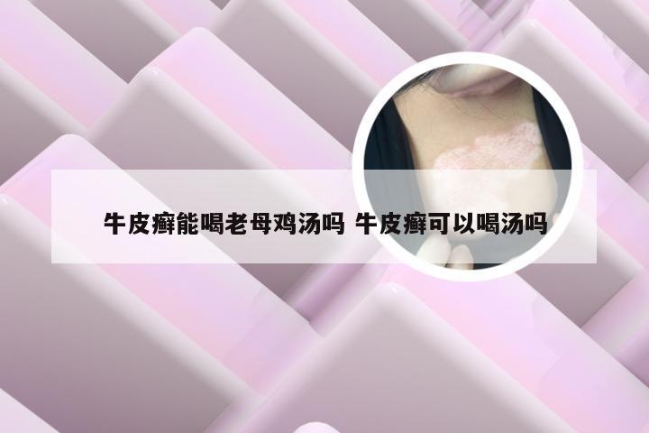 牛皮癣能喝老母鸡汤吗 牛皮癣可以喝汤吗