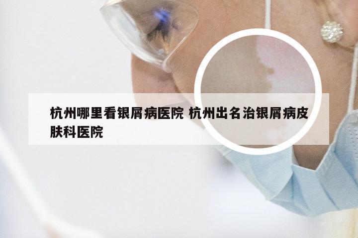 杭州哪里看银屑病医院 杭州出名治银屑病皮肤科医院