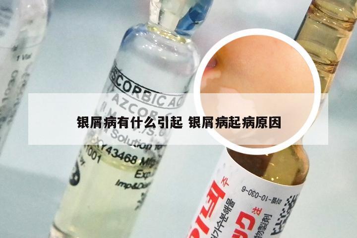 银屑病有什么引起 银屑病起病原因