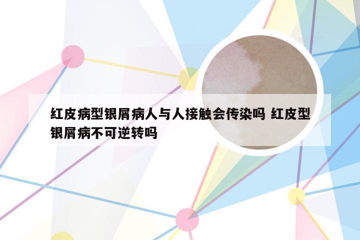 红皮病型银屑病人与人接触会传染吗 红皮型银屑病不可逆转吗