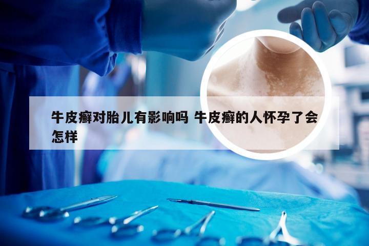 牛皮癣对胎儿有影响吗 牛皮癣的人怀孕了会怎样