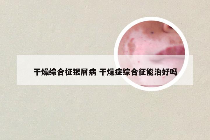 干燥综合征银屑病 干燥症综合征能治好吗